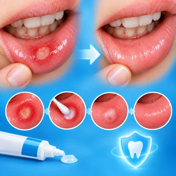 Афтозный стоматит: причины, симптомы и лечение